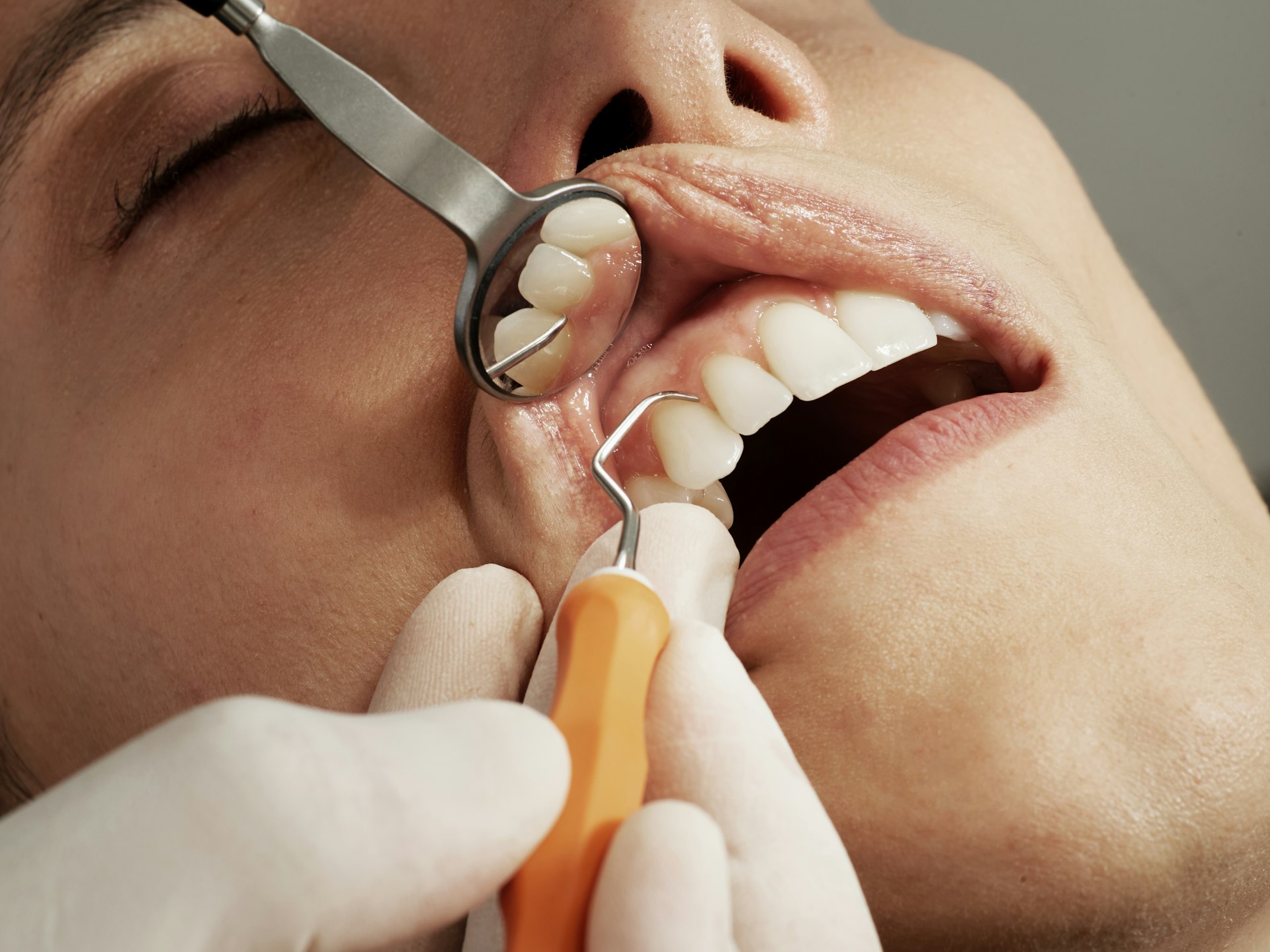 Científicos brasileños crean un biomaterial de jaca y granada que regenera encías y hueso dental dañados 2 Sonrisa y dientes sanos - biomaterial brasileño de látex de jaca y extracto de granada para tratar enfermedad periodontal de la PUC-SP