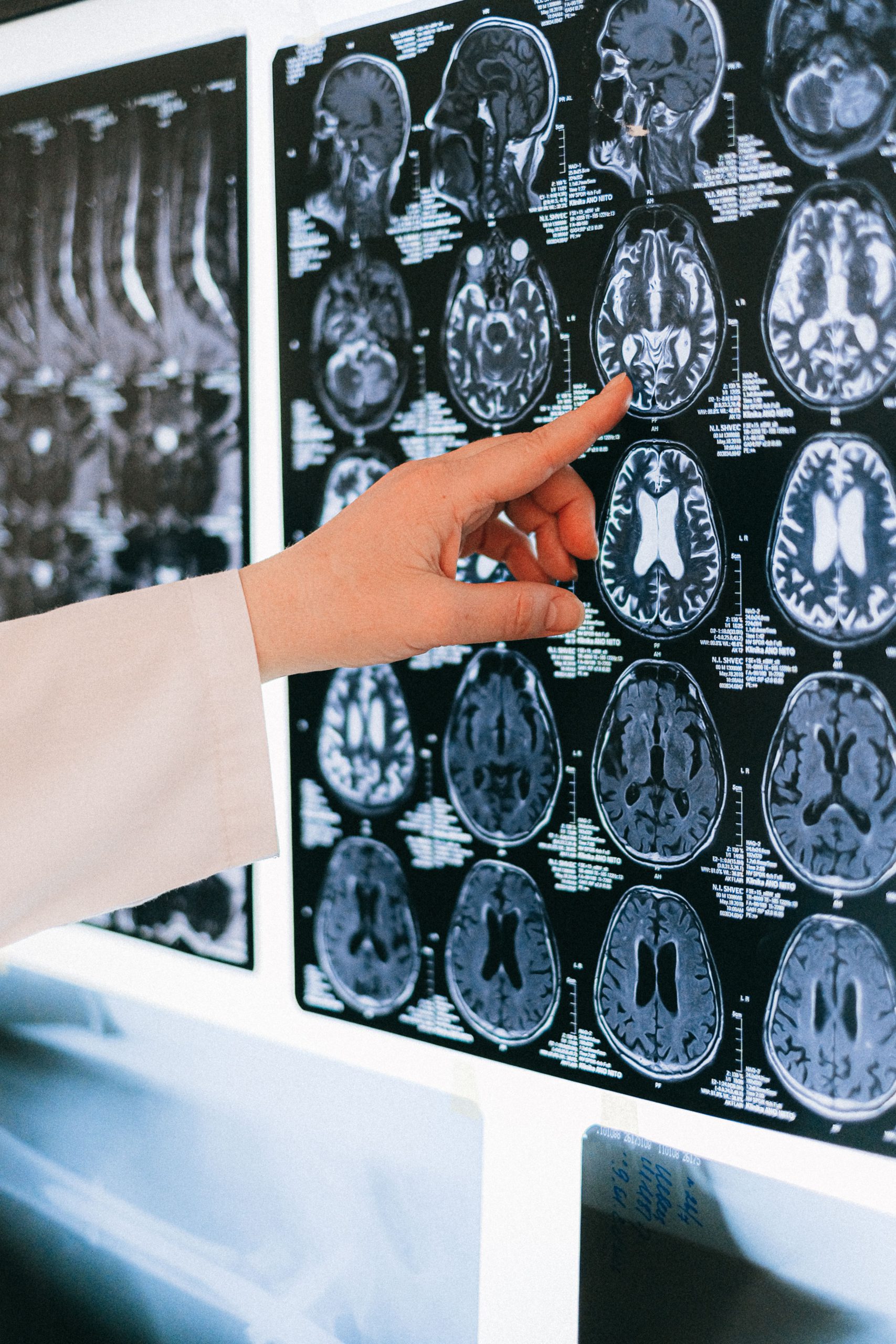 Investigador señalando una resonancia magnética del cerebro en un panel de luz para diagnóstico médico