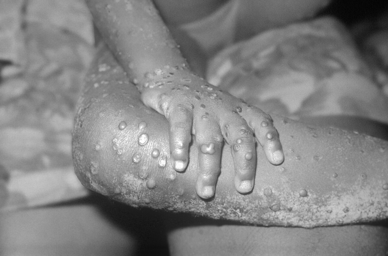 Mpox en África: 1.153 casos nuevos en seis semanas y Madagascar con el mayor brote del mundo 9 Lesiones cutáneas por mpox: la OMS reportó 1.153 casos confirmados en 11 países africanos en seis semanas de 2026