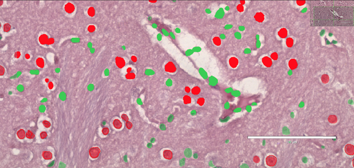 Tecnología de inmunohistoquímica con inteligencia artificial para diagnóstico médico