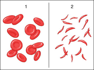 Frotis de sangre con globulos rojos en forma de hoz, caracteristicos de la anemia falciforme