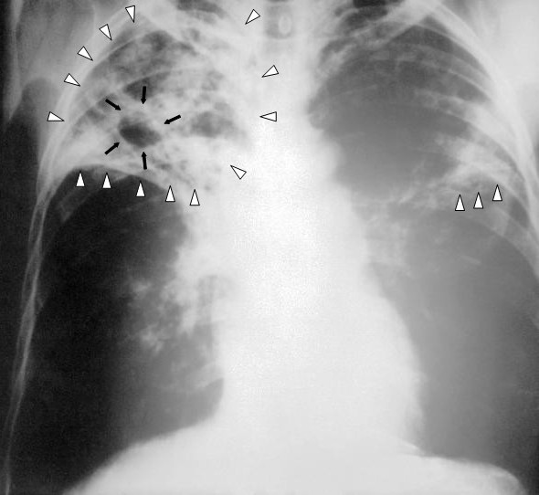 Tuberculosis en Asia: 5 países concentran el 55% de los casos del mundo 2 Radiografia de torax con lesiones compatibles con tuberculosis pulmonar