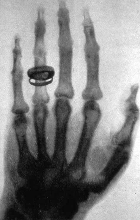 La IA que diagnostica sin internet ya está cambiando la atención primaria en África 2 Radiografía de mano — primer rayo X de la historia, de Wilhelm Röntgen, 1895