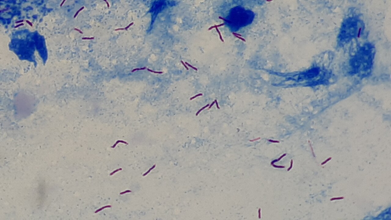 África frena la tuberculosis al doble que el mundo, pero enferma 337.000 niños 5 Frotis de esputo con bacilos ácido-alcohol resistentes al microscopio: la prueba que confirma la tuberculosis pulmonar