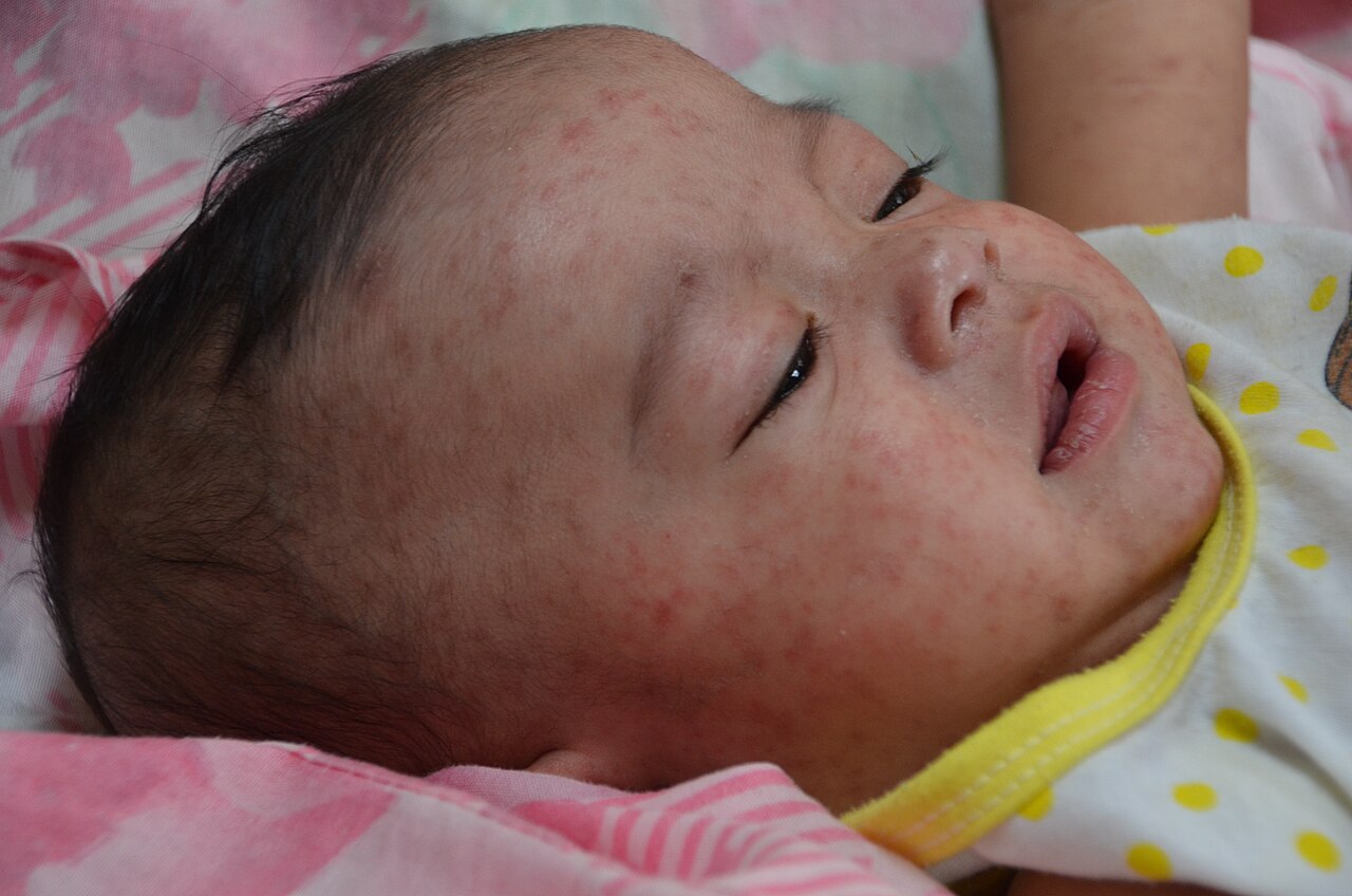 Sarampión en las Américas: 47.459 casos y Guatemala a la cabeza 1 Lactante con sarpullido rojizo en el rostro durante un cuadro de sarampión, enfermedad prevenible con dos dosis de vacuna